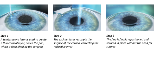 Laser Eye Surgery Procedures - Lasik